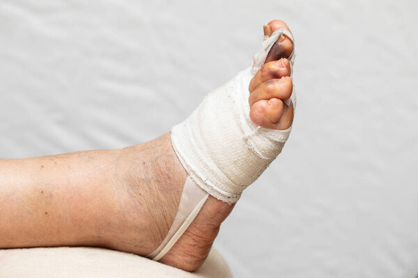 Bandaged foot after hallux valgus corrective operation