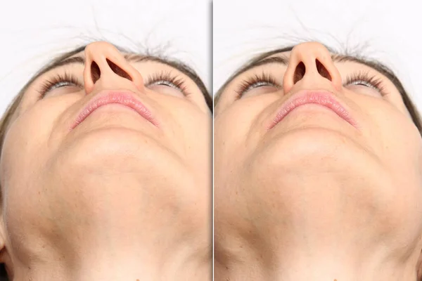 Comparação Desvio Septo Nasal Antes Após Septoplastia — Fotografia de Stock