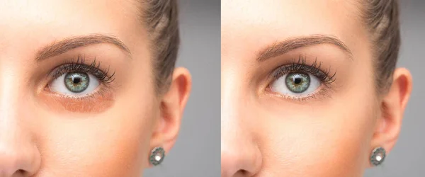治療前と治療後の目の除去の下でのパフィ — ストック写真