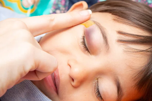 Child face with closed eyes. Blood colored upper eyelid as result of injury or disease. Female hand applying cream to promote heal the wound. Medicine and health care concept.