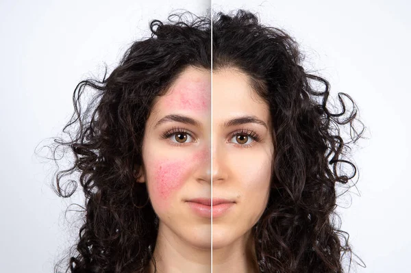 Yüzdeki başarılı rosacea tedavisinden önce ve sonra yakından karşılaştırılmış kolaj. Beyaz arka planda güzel beyaz kadın portresi. Tıp ve sağlık hizmetleri kavramı.
