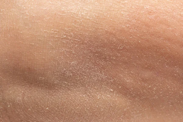 Närbild Detalj Flagnande Mänskliga Epidermis — Stockfoto