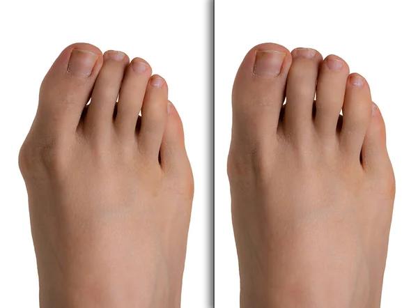 Düzeltici Ameliyattan Önce Sonra Hallux Valgus Ile Ayak — Stok fotoğraf