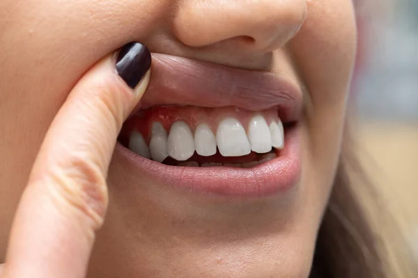 Primer Plano Mujer Tirando Del Labio Superior Con Dedo —  Fotos de Stock