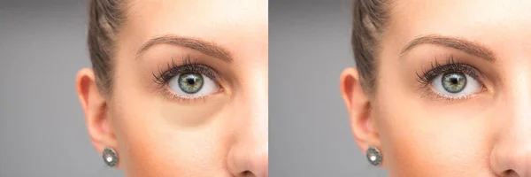 Olhos Antes Depois Eliminação Inchaço — Fotografia de Stock