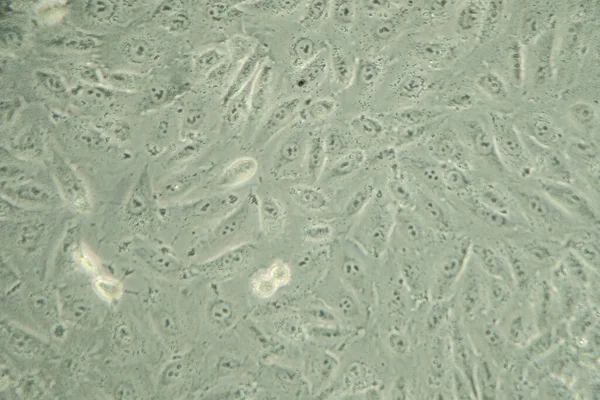 현미경으로 아래있는 암세포 — 스톡 사진