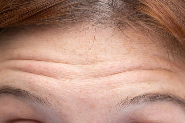 Deep wrinkles in woman forehead