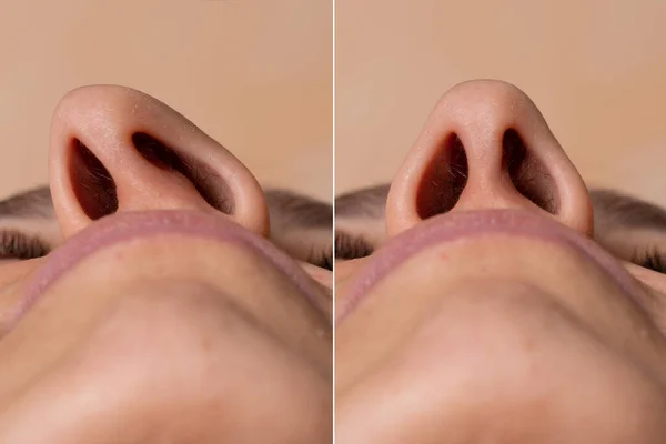 Sebelum Dan Sesudah Rhinoplasty Untuk Memperbaiki Septum Hidung Yang Menyimpang — Stok Foto