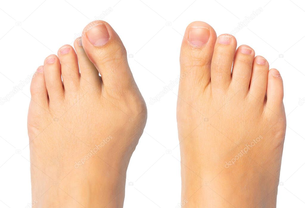 Woman feet before and after surgery for hallux valgus removal