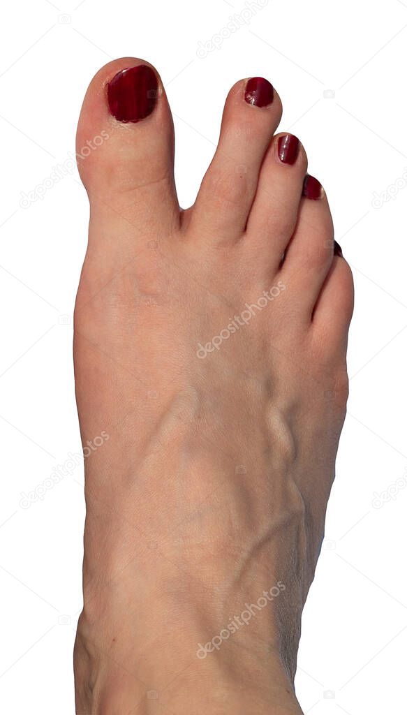 Hallux varus in female feet isolated on white background