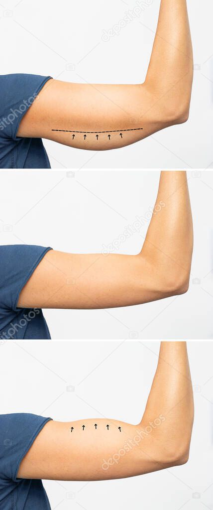 Saggy skin removal and arm before and after toning exercises