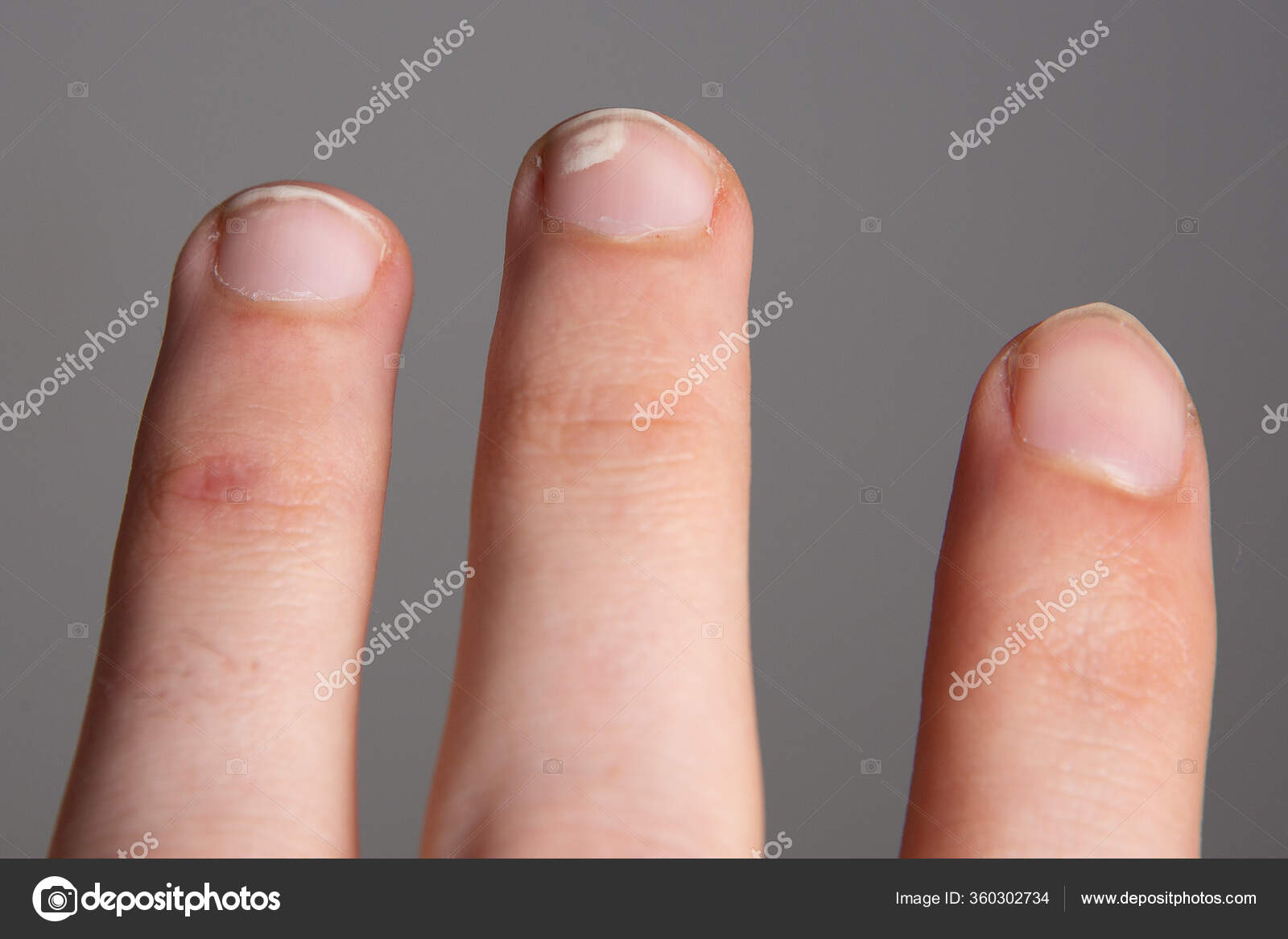 Leukonychia White Spots Nails Calcium Vitamin Deficiency Concept Stock Photo by ©sruilk 360302734 Leukonychia White Spots Nails Calcium Vitamin Deficiency Concept Stock Photo by ©sruilk 360302734