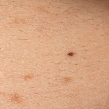 Kusurlu derinin makro görüntüsü