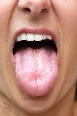 Kadın dilinde Candiasis
