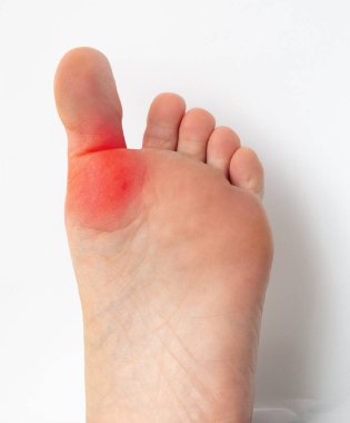 Hallux varus 'tan muzdarip bir kadın.