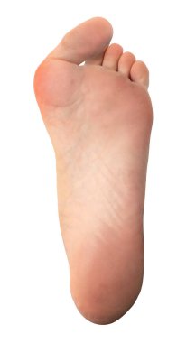 Hallux valgus ile bir ayağın altından görünüm