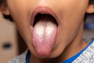 A closeup view of a young child sticking out their white tongue, a common symptom of oral thrush. clipart