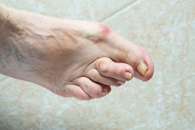 Hallux valgus ayağının şeklini bozmuş.