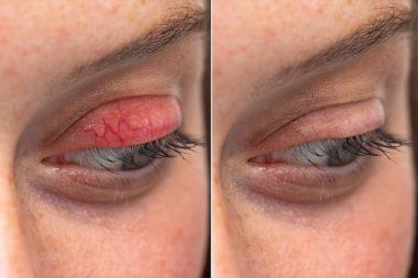 İnsan gözü üst göz kapağı kireçlenmesi yan yana BlePharitis karşılaştırması öncesi ve sonrası