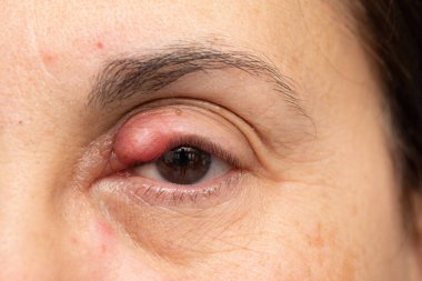 Bayanın gözündeki Chalazion, göz kapağında şişme ve iltihap. Alerjinin tetiklediği kırmızılık
