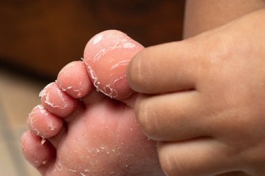 plantar derisinin soyulması: soyulma kavramı