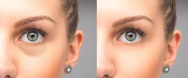 Şişkinliği yok etmeden önce ve sonra gözler