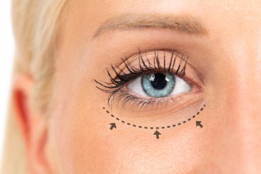 Blepharoplasty ameliyatı için satır