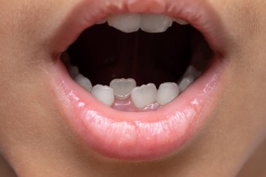 Bir çocuğun açık ağzının kapanması.