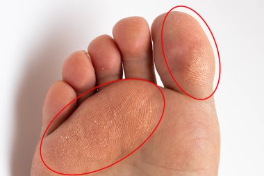 Sole of a woman's foot with thick corns highlighted by red circles clipart