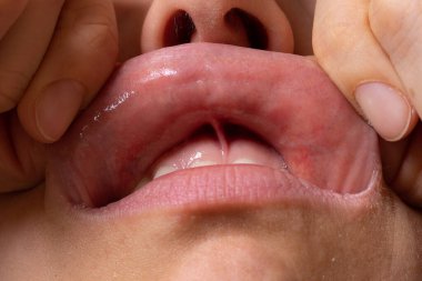 dudak bozuklukları ve hastalıklar: fordyce noktası konsepti ve bunun nasıl önleneceği