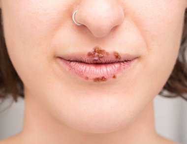 Herpes Simplex (HSV), HSV-1 enfeksiyonunun aşamaları nelerdir