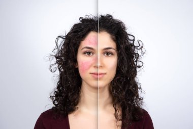 Kolaj, sağlıklı cilt ve yüzün Rosacea, görünür kan damarları ve kılcal damarlarda acı çektiğini gösteriyor. Beyaz arka planda beyaz kıvırcık saçlı kadın portresi. Tıp ve sağlık hizmetleri kavramı.