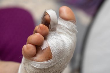 Yara, uzvun kazara yaralanması sonucu iyileşmiş. Hasta yaralı ayağına beyaz bandaj yapıştır. Kaza, acı, ilk yardım ve sağlık hizmeti kavramı