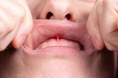 sakız problemleri: nedenler, tedaviler ve belirtilerin nasıl giderileceği