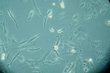 İnsan akciğer kanseri hücreleri