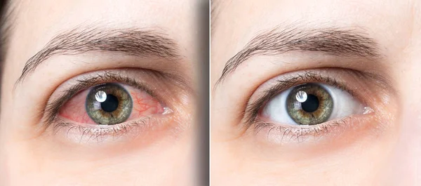 Mulher Olhos Vermelhos Antes Depois Dos Olhos — Fotografia de Stock