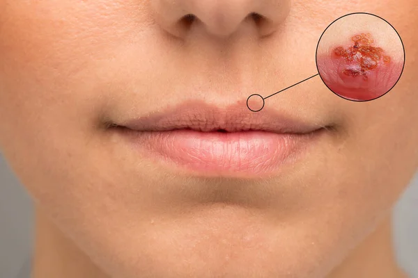 Lip Bruises Caused Herpes Simplex How Recognize Prevent Infection — Stock Photo, Image