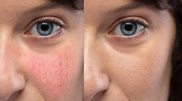 Kolaj, sağlıklı cilt ve yüzün Rosacea, görünür kan damarları ve kılcal damarlarda acı çektiğini gösteriyor. Kafkasyalı kadın yakından bakıyor. Tıp ve sağlık hizmetleri kavramı
