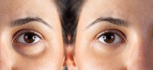 Lower Blepharoplasty Treatment — Stock Photo, Image