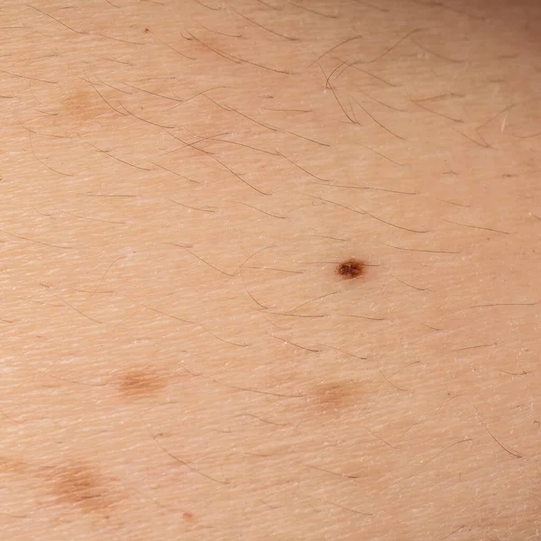 Kusurlu derinin makro görüntüsü