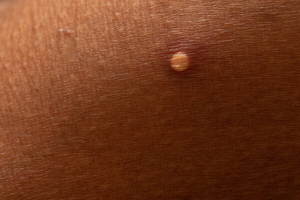 Skin pustule closeup on dark skin