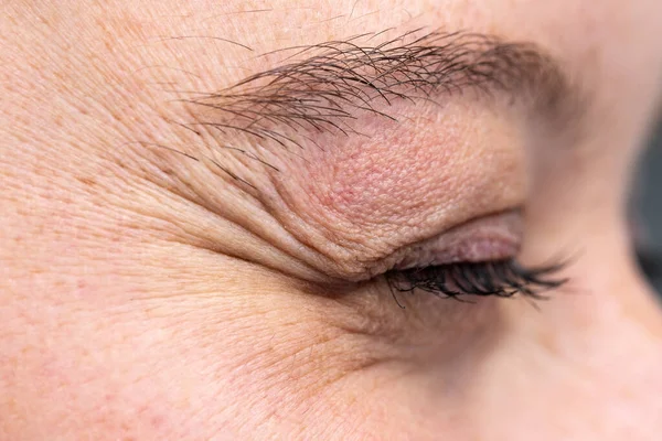 Wrinkled Eye Young Woman Showing Crow Feet — Stock Photo, Image