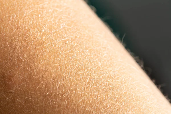 Kuru cildin makro resmi