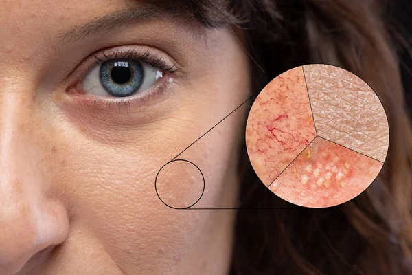 乾燥肌 ヘルペスウイルスによるにきびの赤みを示す皮膚の拡大表示 — ストック写真