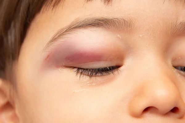 Çocuk Yüzü Kapalı Göz Burun Ayrıntıları Yaralanma Hastalık Sonucu Kan — Stok fotoğraf