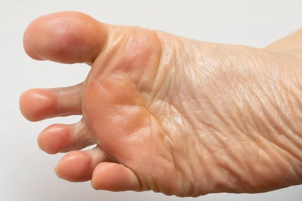 Лікування Натуральними Оліями Ніг Сухою Шкірою Крупним Планом Жіночої Ноги — стокове фото