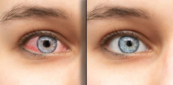 Before and after closeup view of caucasian female red irritated and healthy eye. Healthcare and eyecare concept