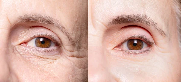 Olhos Senhora Antes Depois Tratamento Beleza — Fotografia de Stock