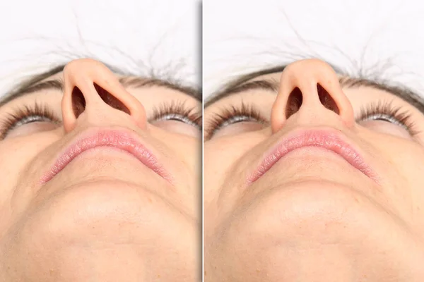 Colagem Comparando Situação Antes Depois Rinoplastia Corrigindo Desvio Septo Nasal — Fotografia de Stock