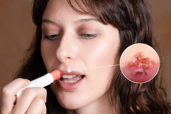 Girl Who Treating Herpes Simplex Infection Viral Cream Based Lip — Stock Photo, Image